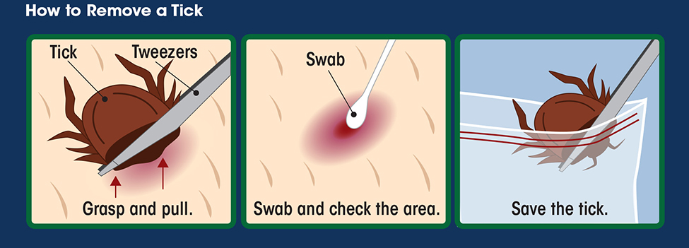 Three panel illustration on how to remove a tick after it has bitten a person